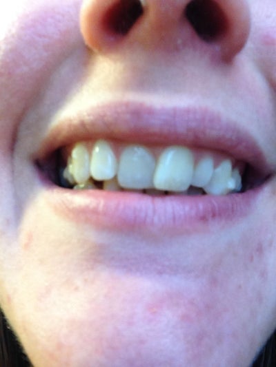 CAT SINGLE BOTTOM CLIP (BOTS)